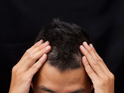 M字ハゲにおすすめの育毛剤7