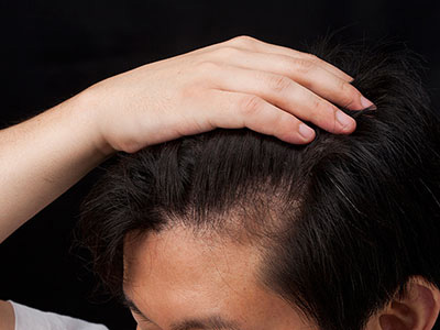 M字ハゲにおすすめの育毛剤9