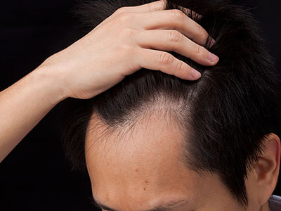 M字ハゲにおすすめの育毛剤8